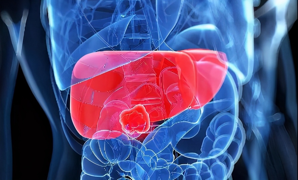 乙肝抗病毒后得肝硬化肝癌的几率,乙肝抗病毒治疗后转肝癌的几率