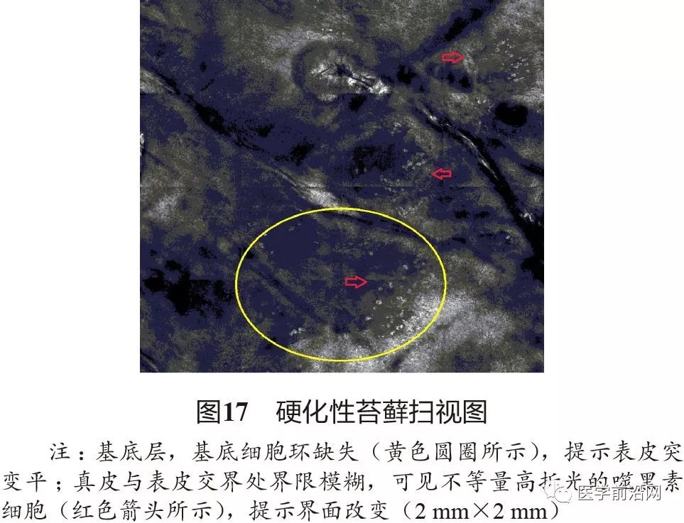 炎症性皮肤病反射式共聚焦显微镜诊断特征专家共识全文发布