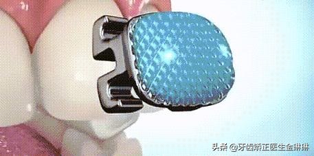 牙齿矫正舍不得给孩子拔牙,矫正牙齿不想戴牙套怎么办