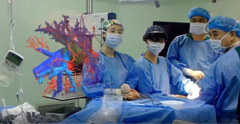 肝胆外科肝血管瘤微波消融,肝肿瘤新技术