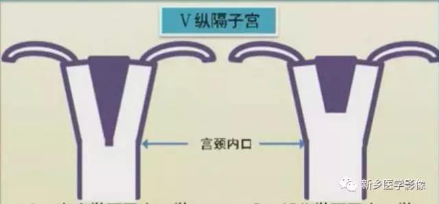 子宫发育异常，应想到的6大类常见畸形