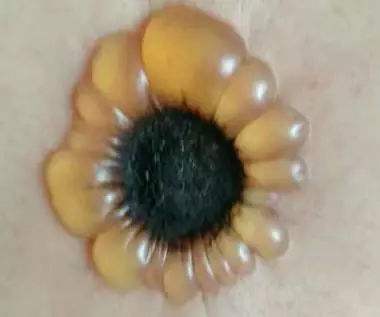 化脓灸是不是把肉灸出疤,古人的化脓灸不会损害身体吗