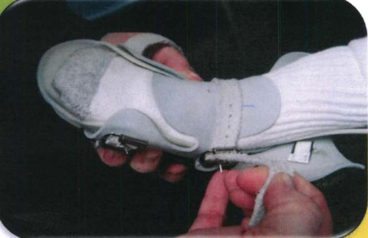 马蹄内翻足支具需要穿多久,马蹄内翻足穿鞋了怎么按摩