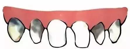 你们听说过奶瓶龋吗,如何正确防止奶瓶龋齿