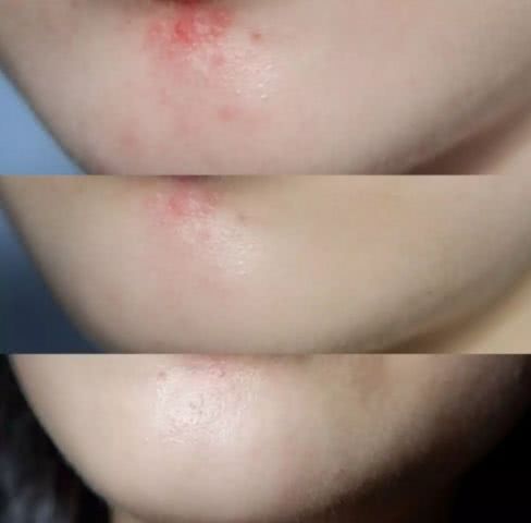 淡斑祛痘印什么产品最有效,淡斑美白祛痘印