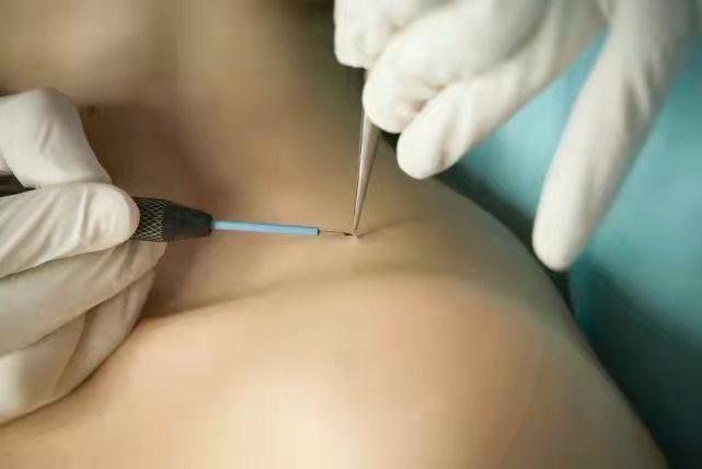 脖子上的小揪揪揪掉还会长吗,脖子上的小揪揪会传染吗