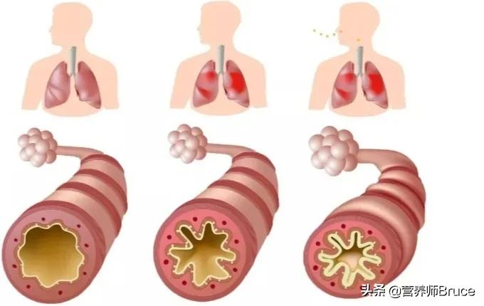 哮喘每晚呼吸困难,哮喘天天犯怎么办