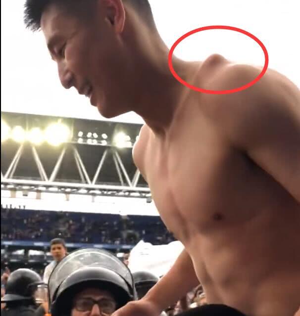 肩锁关节脱位治疗,肩锁关节脱位