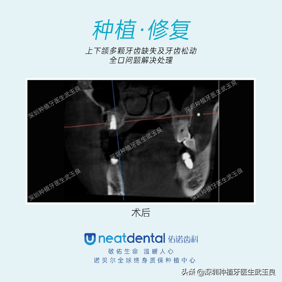 多颗牙齿缺失怎么修复全过程,多颗缺失牙修复案例