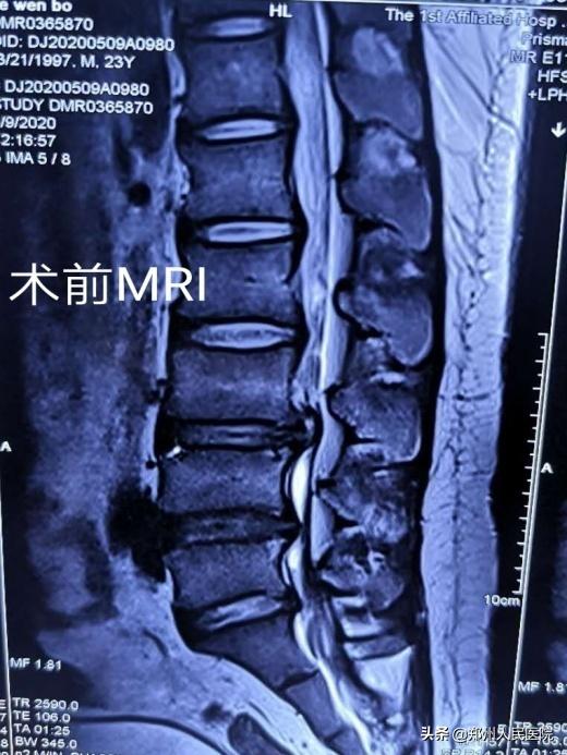 对骨科微创技术的认识,骨科手术与保守治疗对比