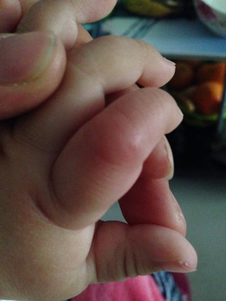 宝宝手指变异什么原因,宝宝手像猪蹄