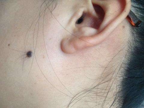 黑痣上长毛是好痣还是坏痣,痣上长毛可以剪掉吗