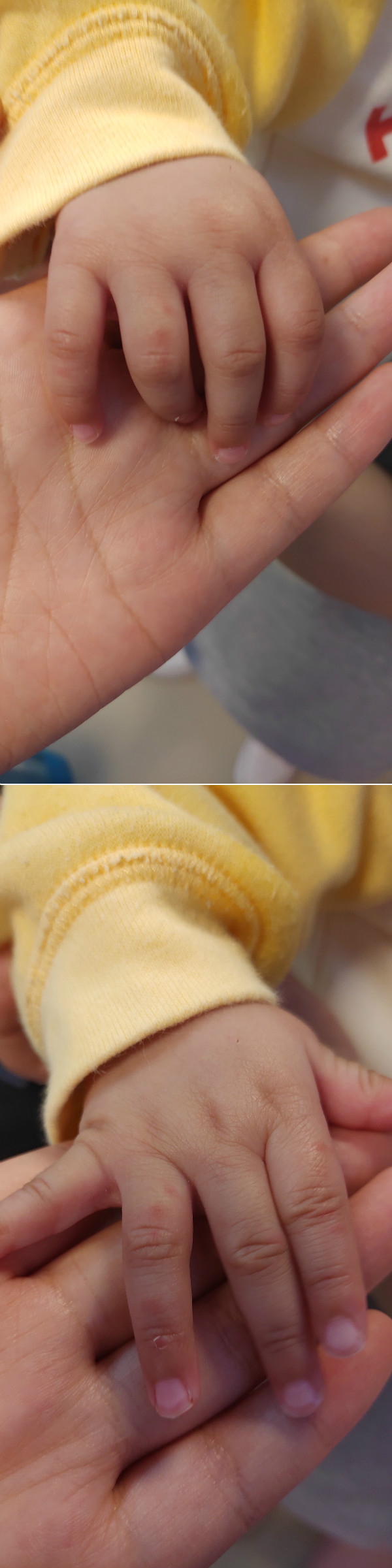 孩子的手过敏红肿怎么办,五个月宝宝手红肿了怎么回事