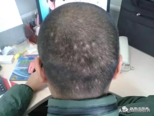 斑秃儿童饮食,饮食油腻会导致斑秃吗