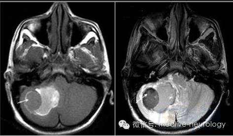 脑出血磁共振t1t2表现,10分钟记住脑出血核磁表现