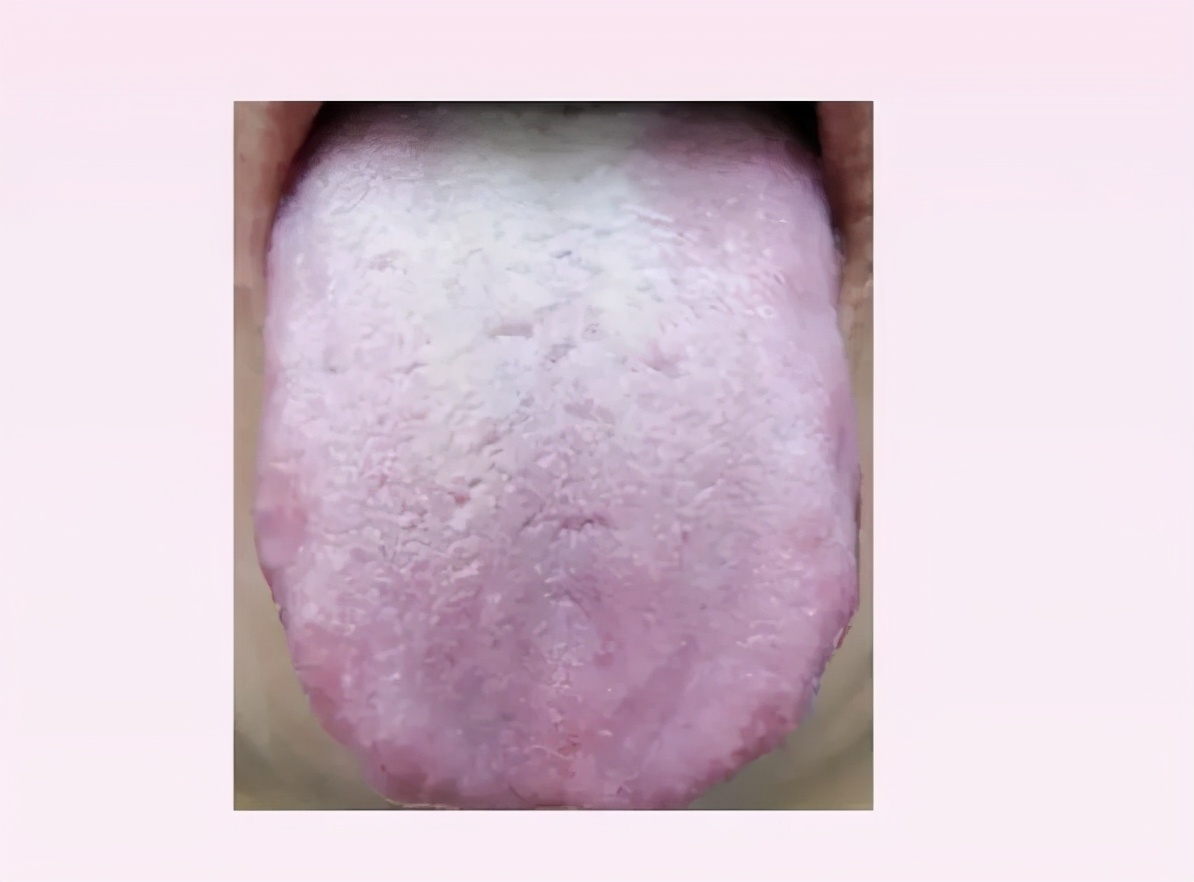 经常听人说湿气重到底湿气是什么,常说的湿气重是什么