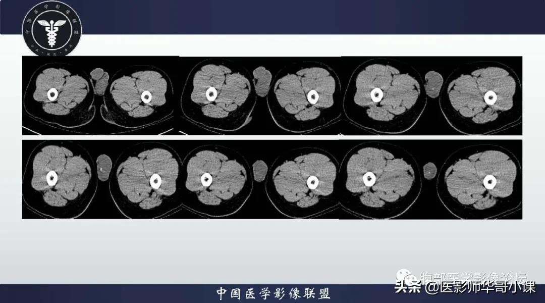 [精品课件]畸胎瘤及精原细胞瘤（*丸睾**肿瘤及肿瘤样变CT及MR表现）