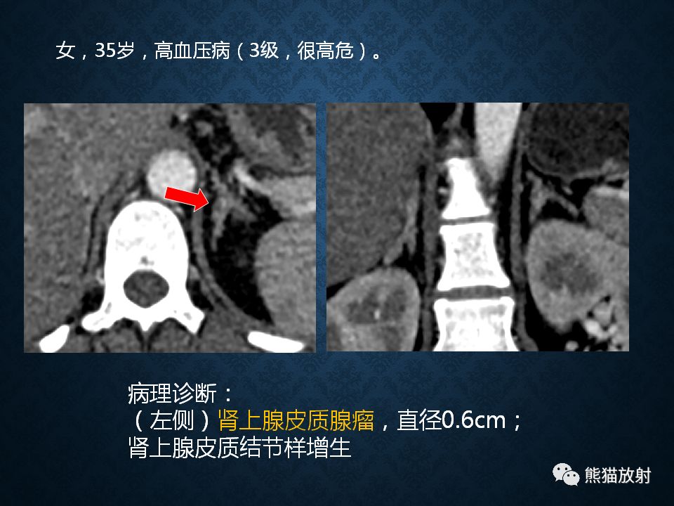 纵隔和肾上腺恶性肿瘤,纵隔性肿瘤位置图