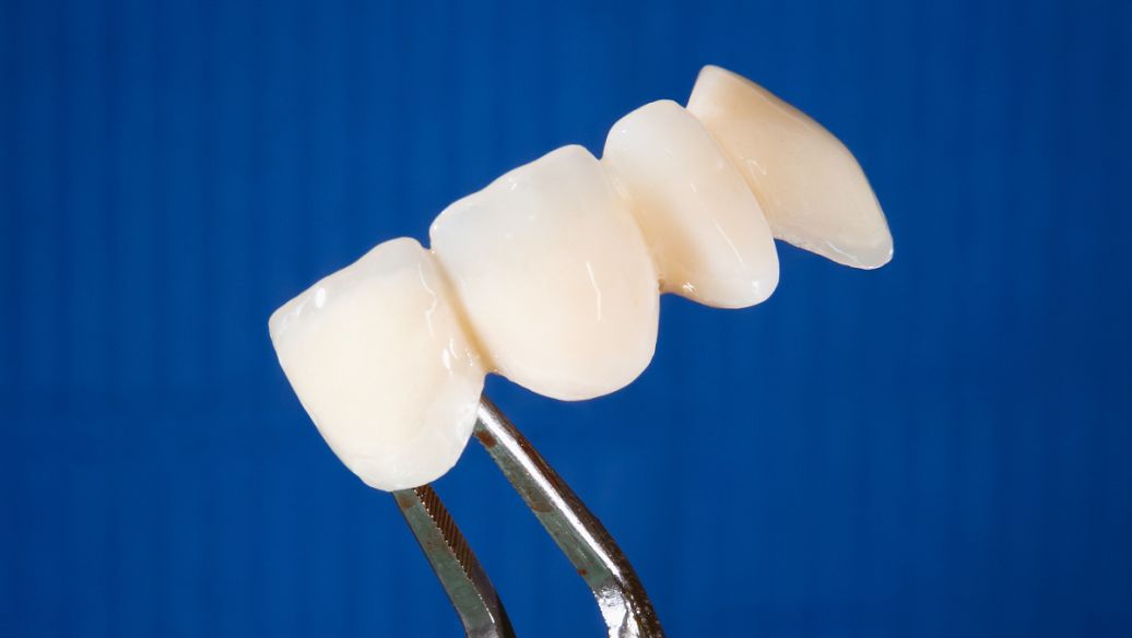 钴铬合金烤瓷牙牙龈变黑怎么处理,烤瓷牙崩瓷了怎么修复