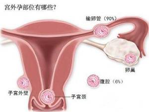 孕卵迷路潜藏危机——出血、腹痛甚至危及生命！