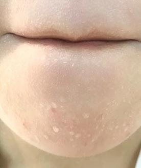 脸上长闭口怎么办教你正确去闭口,去闭口最简单的消除方法