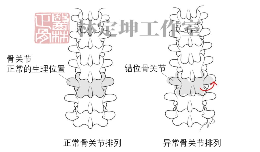 腰痛中药敷腰,正骨治疗腰椎疼痛有效缓解么