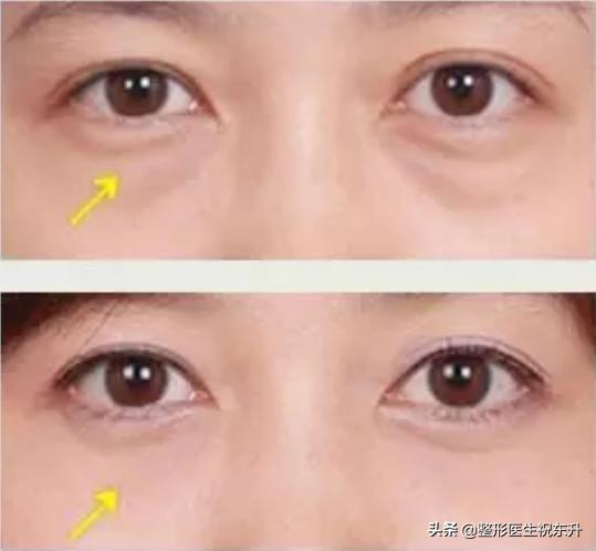 眼袋困扰多年不要急试试这个方法,消除眼袋也有省钱又省时的好方法