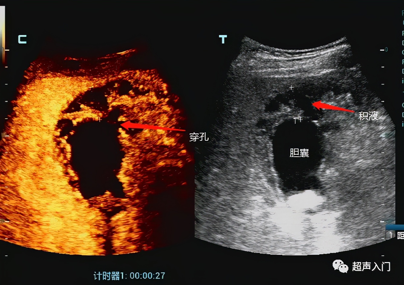急性胆囊炎超声表现入门教学视频,急性胆囊炎超声诊断怎么写