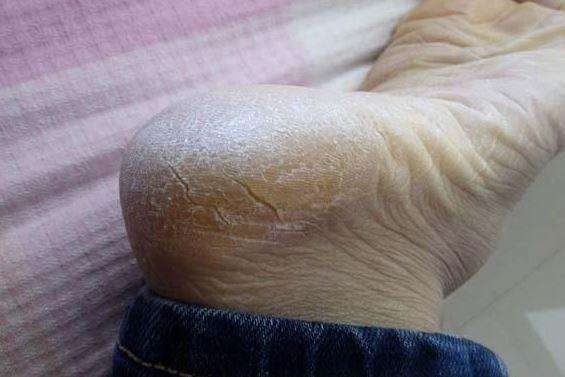 脚后跟干裂开口子吃什么维生素,脚后跟干裂是缺乏什么吗