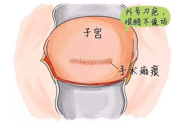 子宫瘢痕处妊娠差点要了我的命！