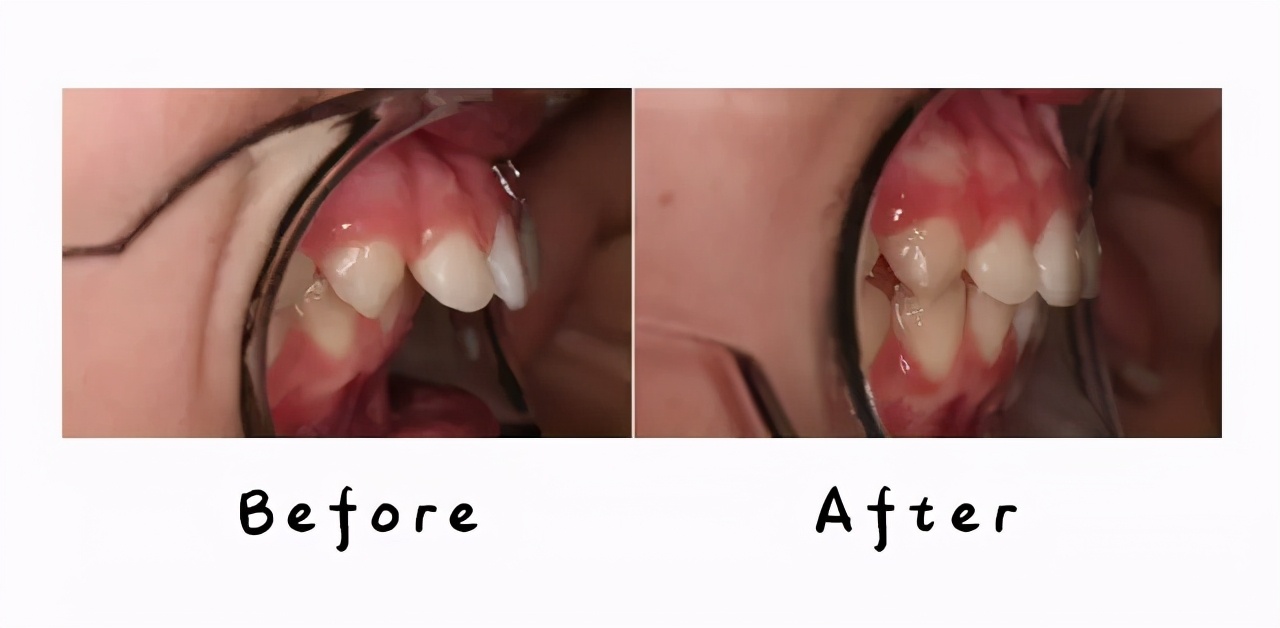 mrc矫正器小孩子晚上不愿意咬,mrc儿童牙齿矫正