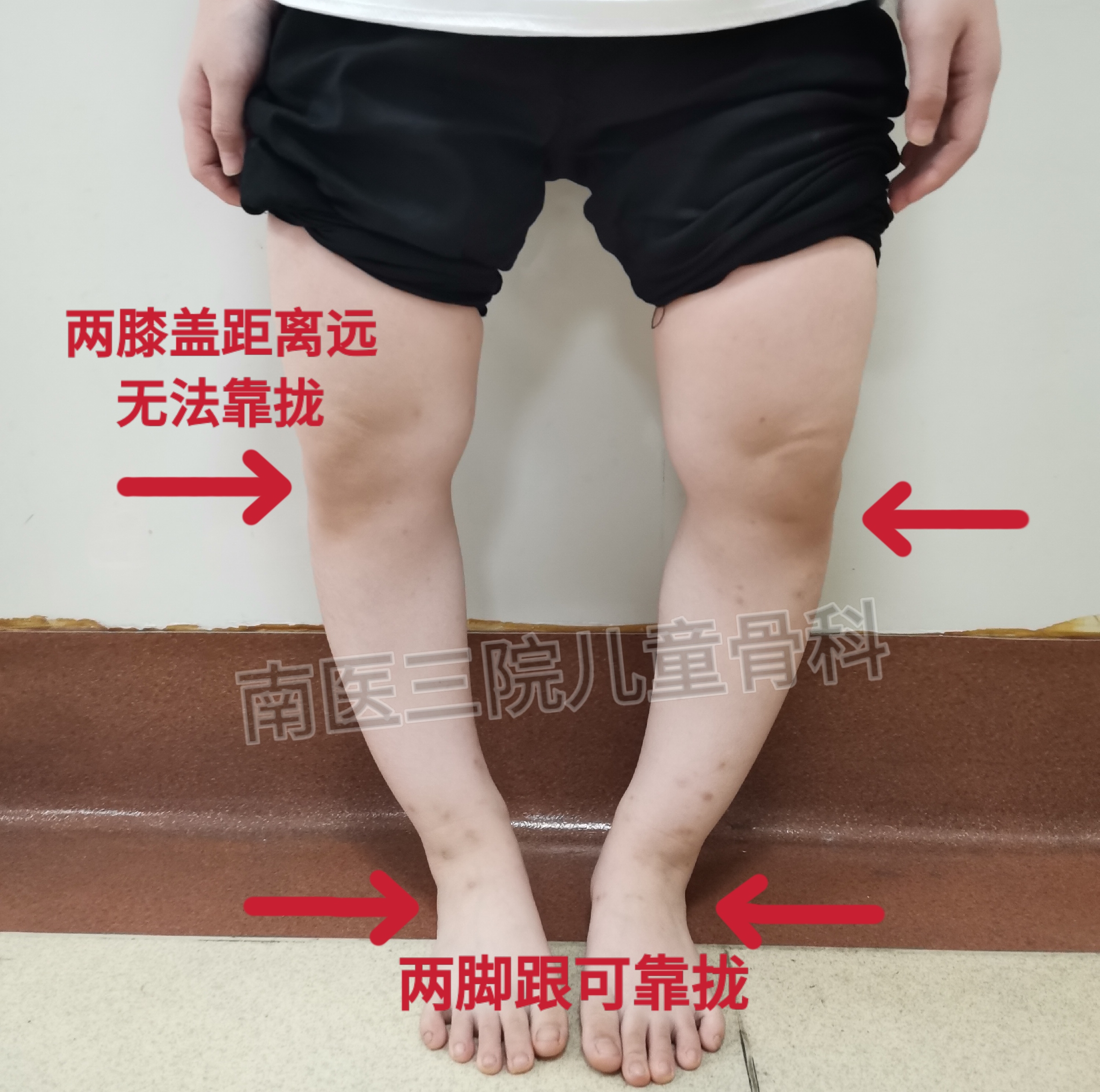 小孩子o型腿绑腿可以矫正过来吗,绑腿矫正o型腿婴儿1岁半