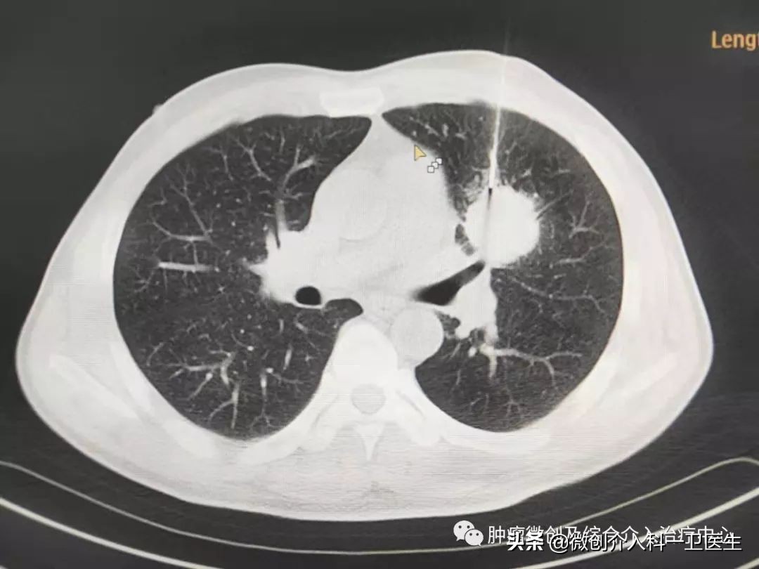 运城市第一医院肿瘤手术,运城市第一医院微创介入手术
