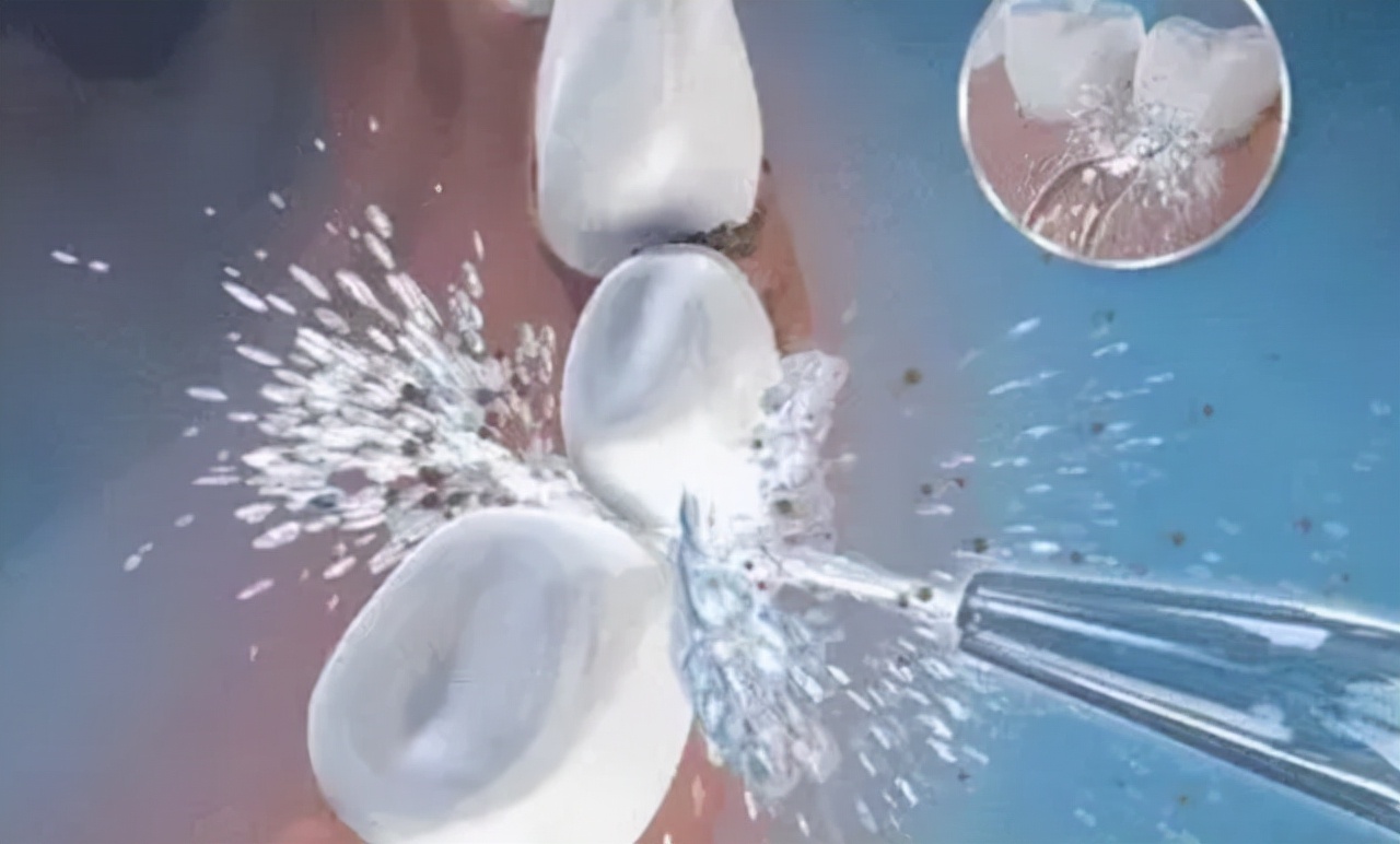 牙缝的黑色是牙结石吗可以抠掉吗,牙缝牙结石可以自己抠掉吗