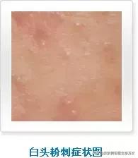 痘痘十大真相,痘痘大全图解