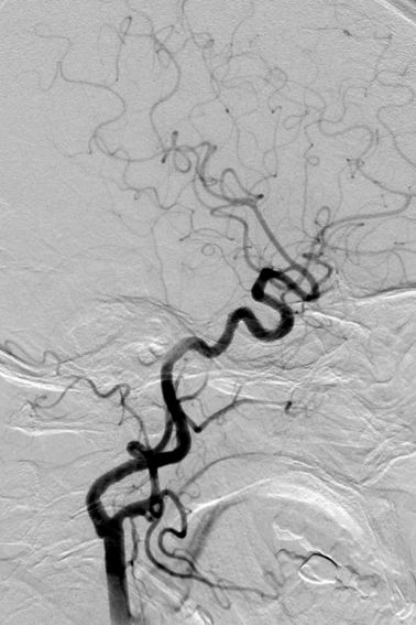Tubridge®治疗多发性动脉瘤
