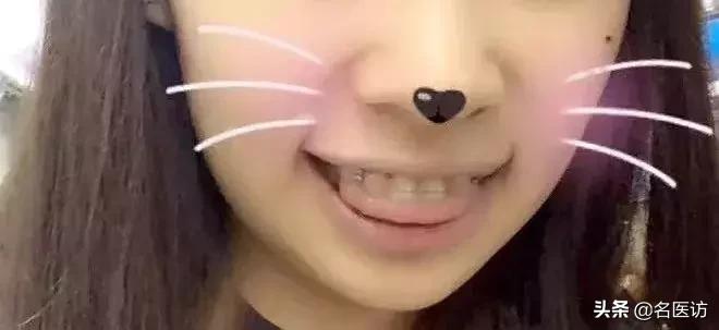 戴牙套2年不戴保持器反弹案例,戴牙套成功案例不戴保持器