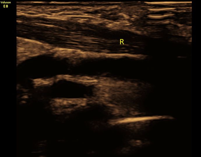 八个月大宝宝锁骨断了,新生儿锁骨断了错位
