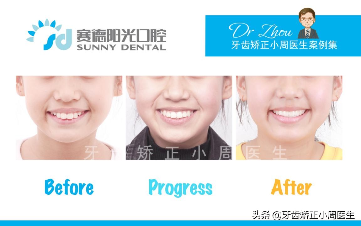 下巴后缩整容玻尿酸还是假体,如何不靠整容改变下巴