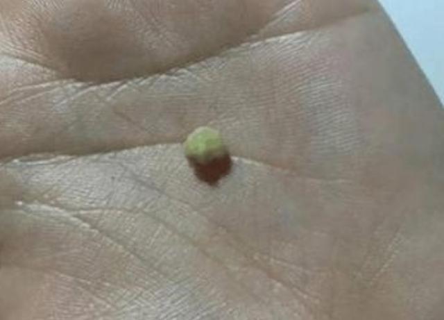 8岁小朋友口臭厉害怎么办,孩子口臭被同学嫌弃怎么办