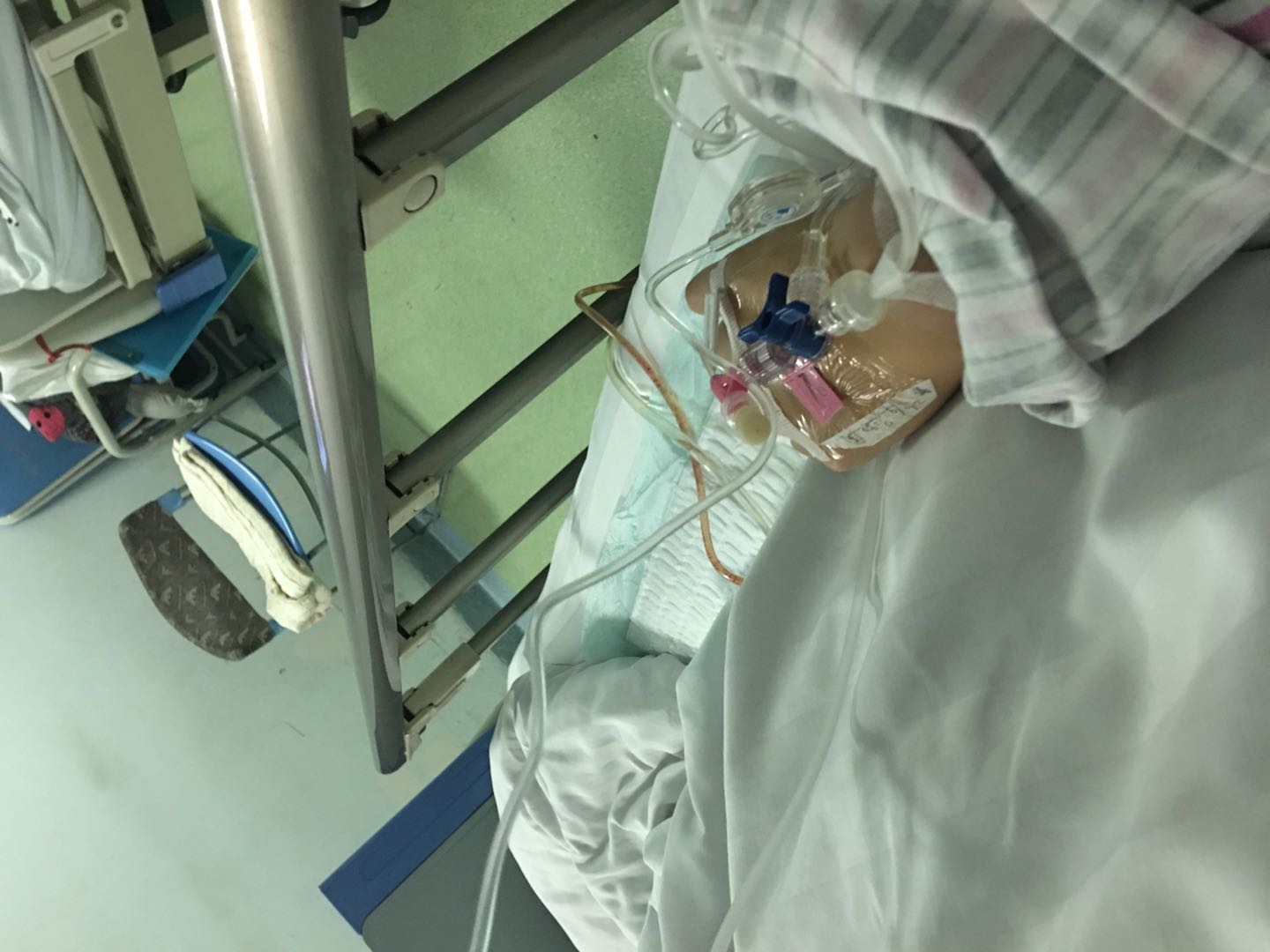 2次宫外孕的心酸,左右两侧都有过宫外孕的经历