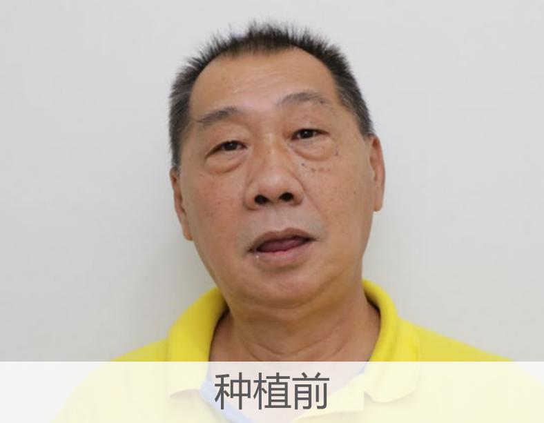 烤瓷牙延长寿命的方法,烤瓷牙的修复方法