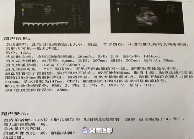 女性32岁胎盘早剥大出血,34周孕妇突然胎盘早剥大量出血