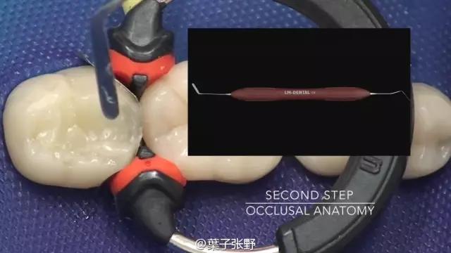 补牙疼吗补牙过程图,补牙全部过程是什么样子的