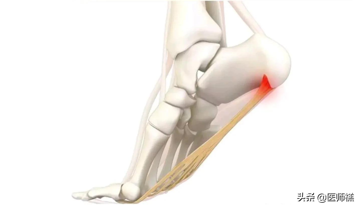 足底筋膜炎吃普通消炎药能缓解吗,足底筋膜炎睡一觉可以缓解吗