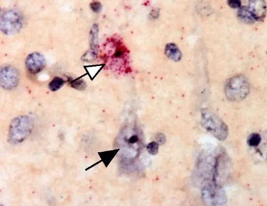 法国发现最新传染疫情,巴黎发现神秘病毒