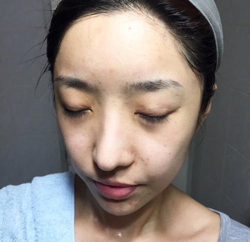 头顶毛囊油脂堵塞毛孔图,清理毛囊油脂疏通毛孔额头