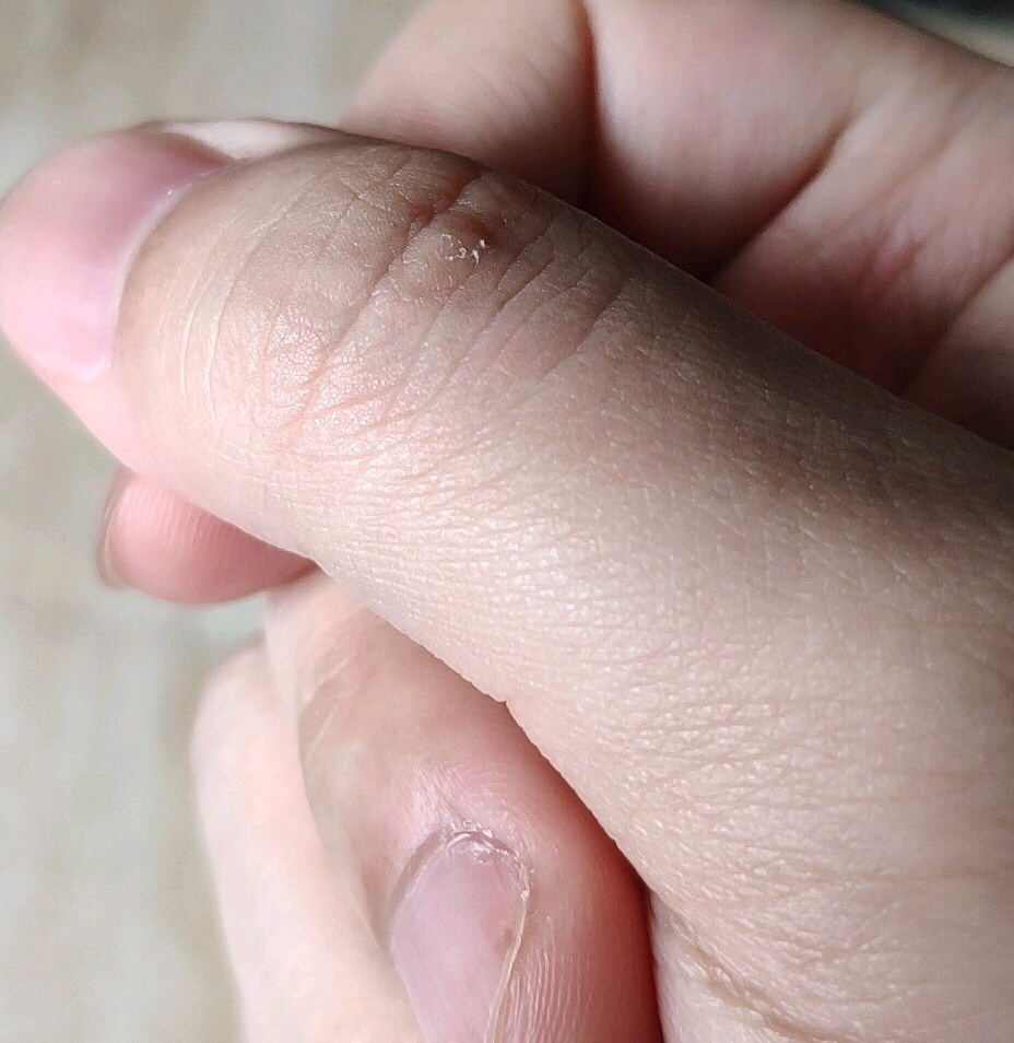 痛风合并股骨头怀死的患者应该如何锻炼