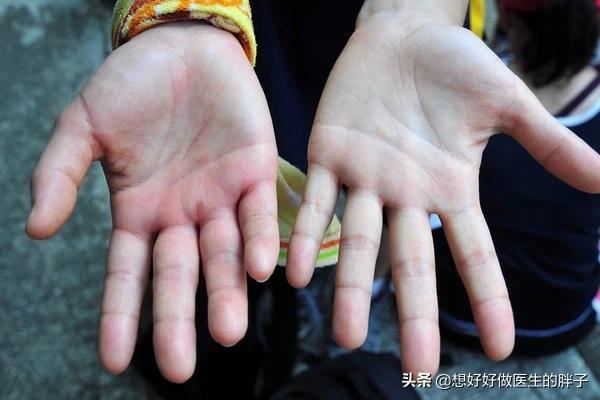 一跑步手就肿怎么回事,走路跑步身体发痒什么原因