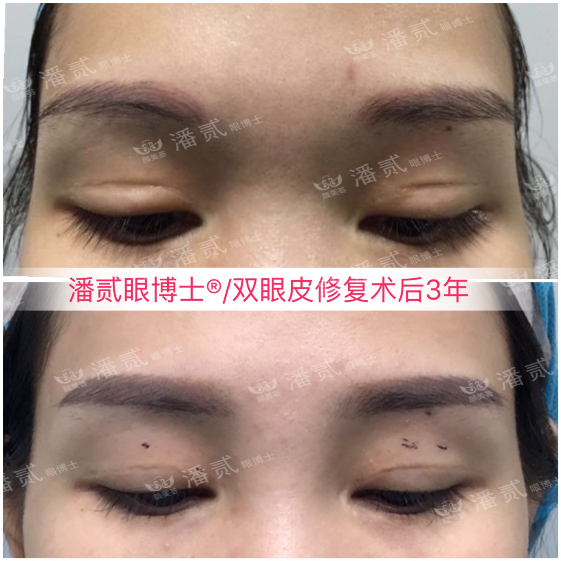 请别再怀疑潘贰做双眼皮手术切肌肉了，希望这是我最后一次澄清